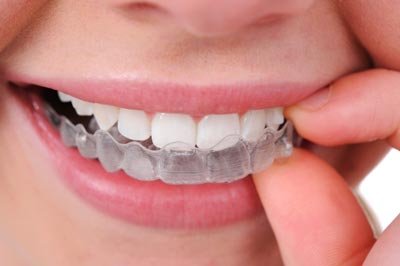 Achieving a Perfect Smile with Braces Teeth Invisible